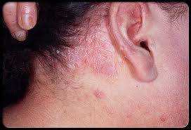 Bệnh Vẩy Nến Ở Lưng